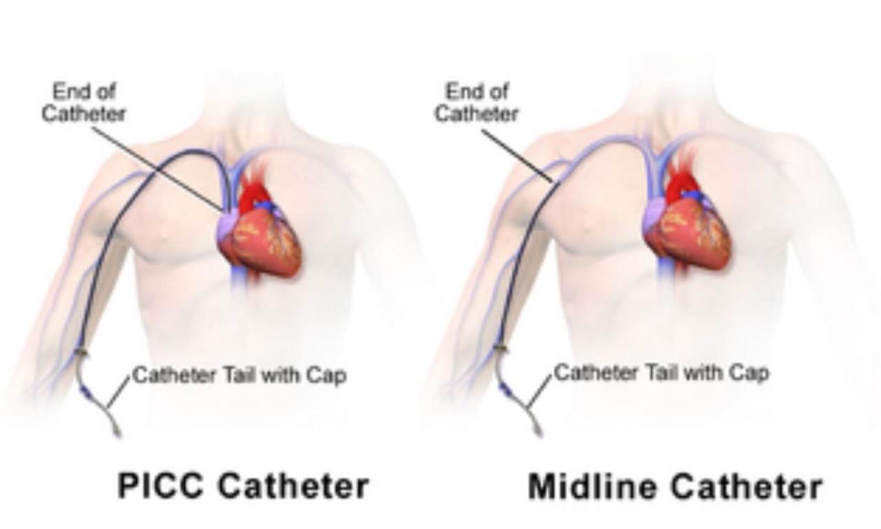 Central Catheters Safer Than Piccs For Short-Term Venous Access: Jama