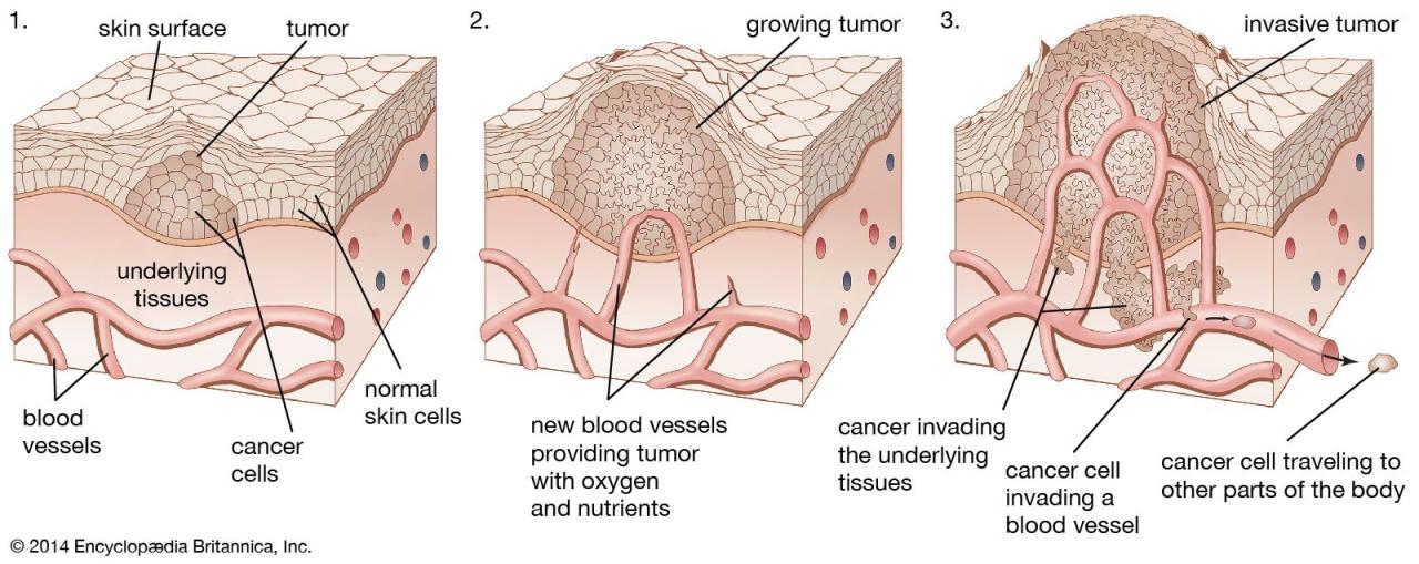 Tumour | Causes, Diagnosis & Treatment | Britannica