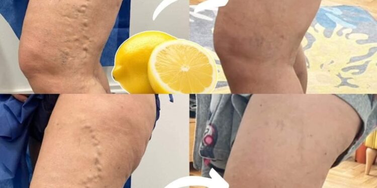 Lemon for Varicose Veins: A Simple Natural Remedy‎‎