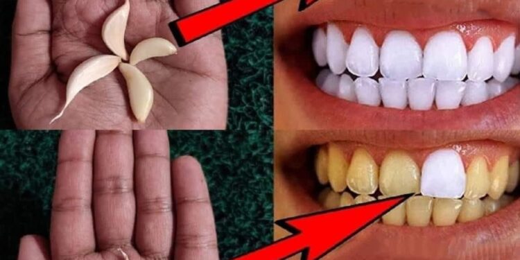 Why Garlic is Most Important for Teeth Whitening: A Comprehensive Guide